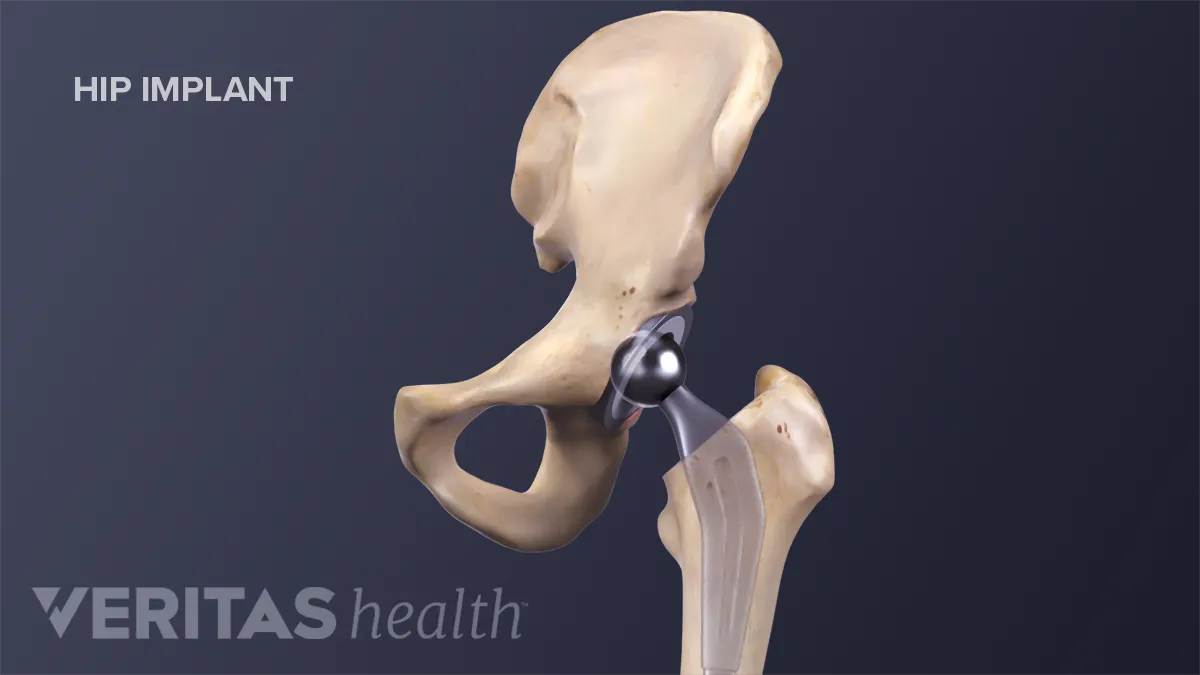 Total Hip Replacement Surgery Risks and Complications
