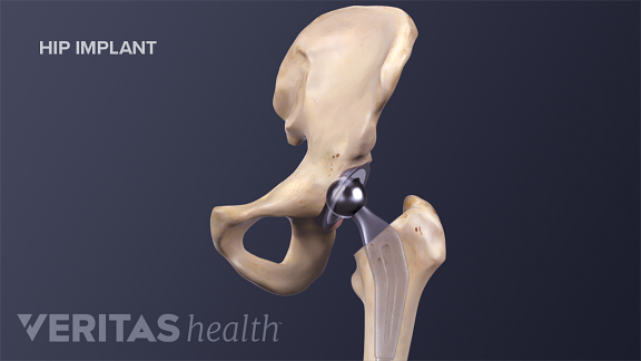 Completed Hip Joint Replacement Completed Hip Joint Replacement
