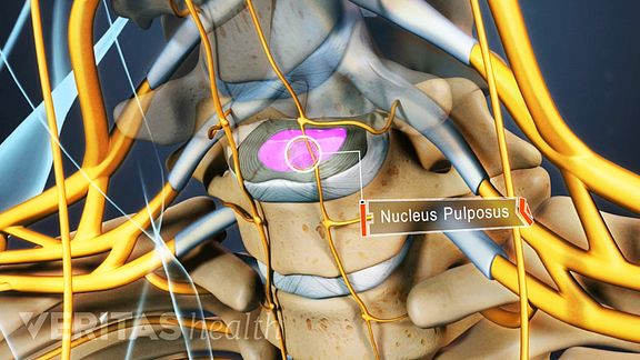 A Visual Guide to How Cervical Discs Degenerate