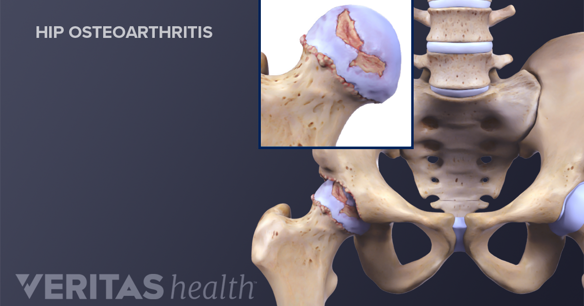 Is My Hip Pain From Arthritis Or Bursitis