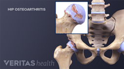 Medical illustration of osteoarthritis in the hip joint