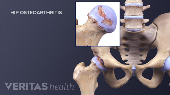 Medical illustration of a hip joint. Inset shows cartilage wear which is also called osteoarthritis.