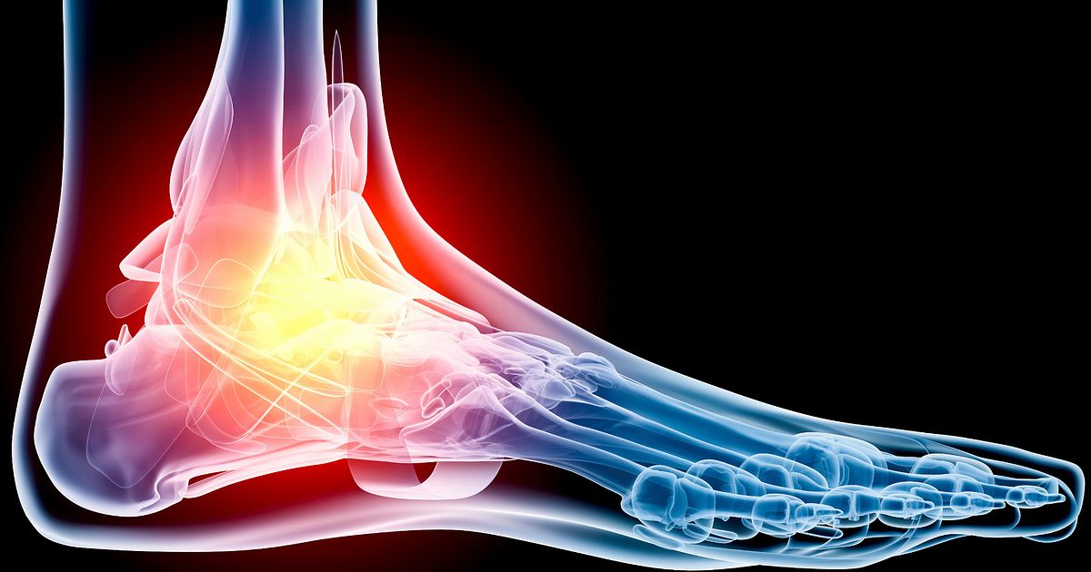 foot arch pain after running