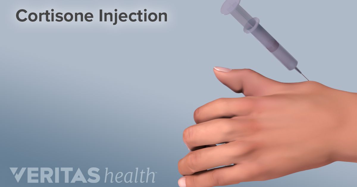 Cortisone Injection Procedure