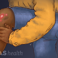 Focus on the left knee showing psoriatic arthritis.