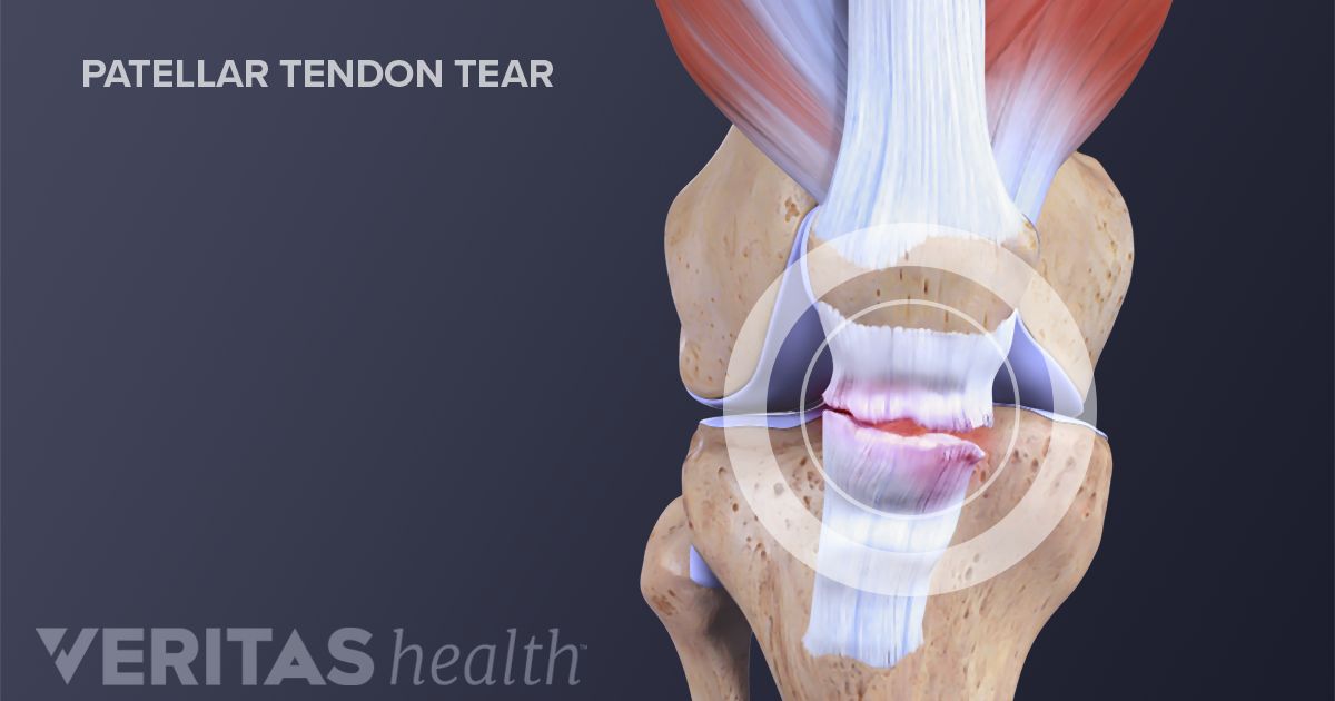 patellar-ligament-vs-patellar-tendon