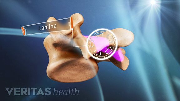 A Visual Guide To Lumbar Laminectomy Surgery 