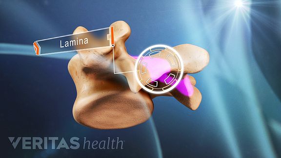 lumbar laminectomy