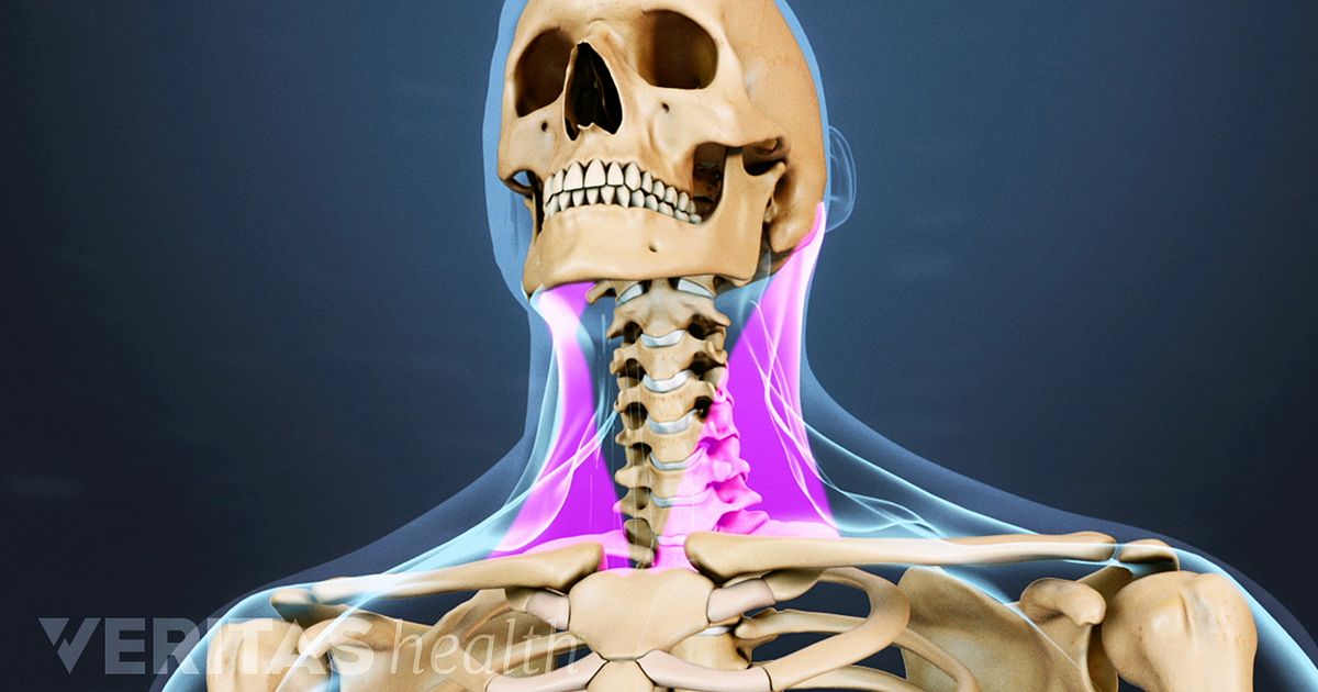 Neck Strain: Causes and Remedies