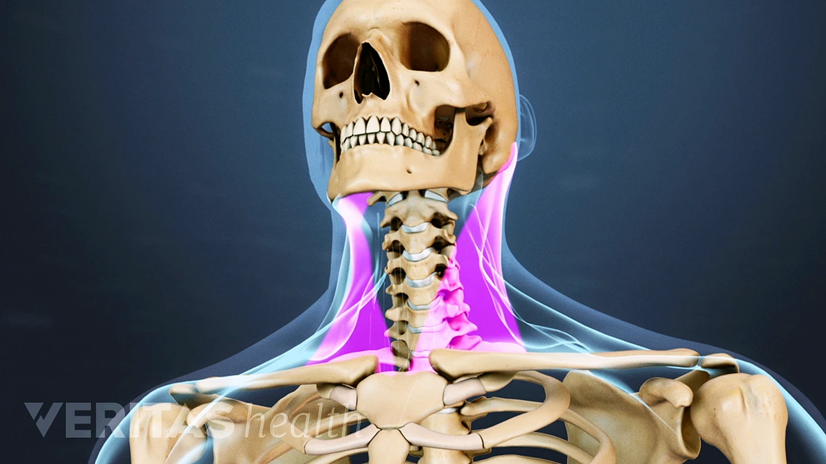 Neck Strain: Causes and Remedies