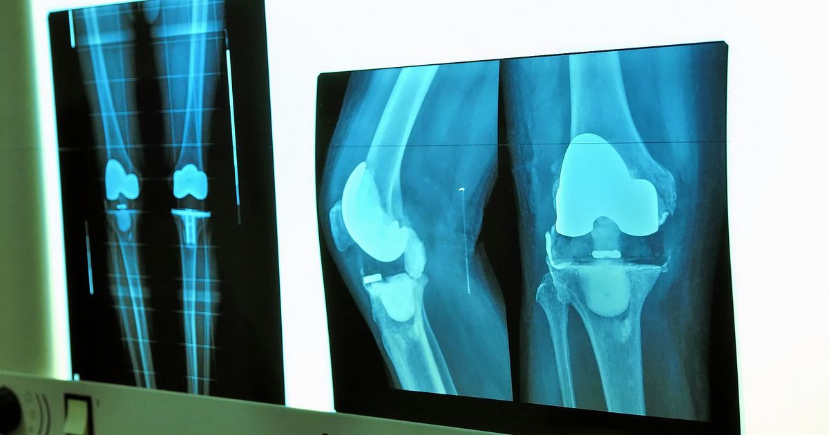 why-have-a-double-knee-replacement