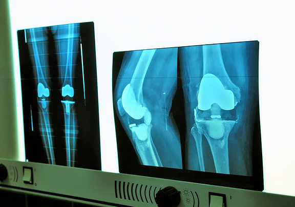 knee replacement x-rays