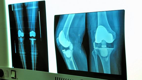 why-have-a-double-knee-replacement