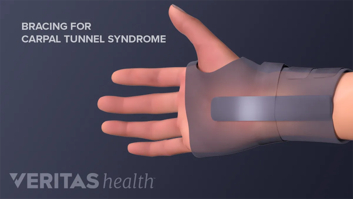 carpal tunnel syndrome symptoms