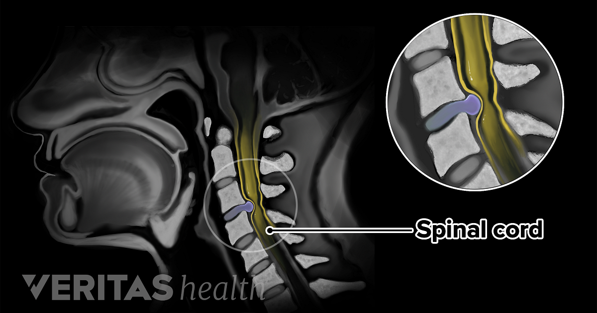 cervical spondylosis with myelopathy cervical spondylosis with myelopathy
