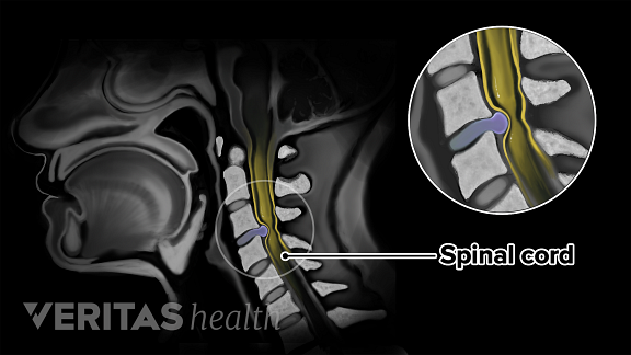 Profile view of cervical spine on an MRI showing the spinal cord