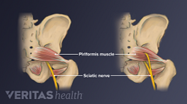 Medical illustration showing sciatic nerve and piriformis muscle