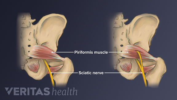 Sciatica variants highlighting piriformis muscle and sciatic nerve.