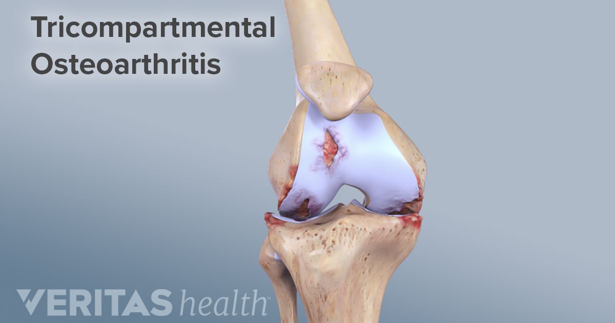 Knee Osteoarthritis Symptoms