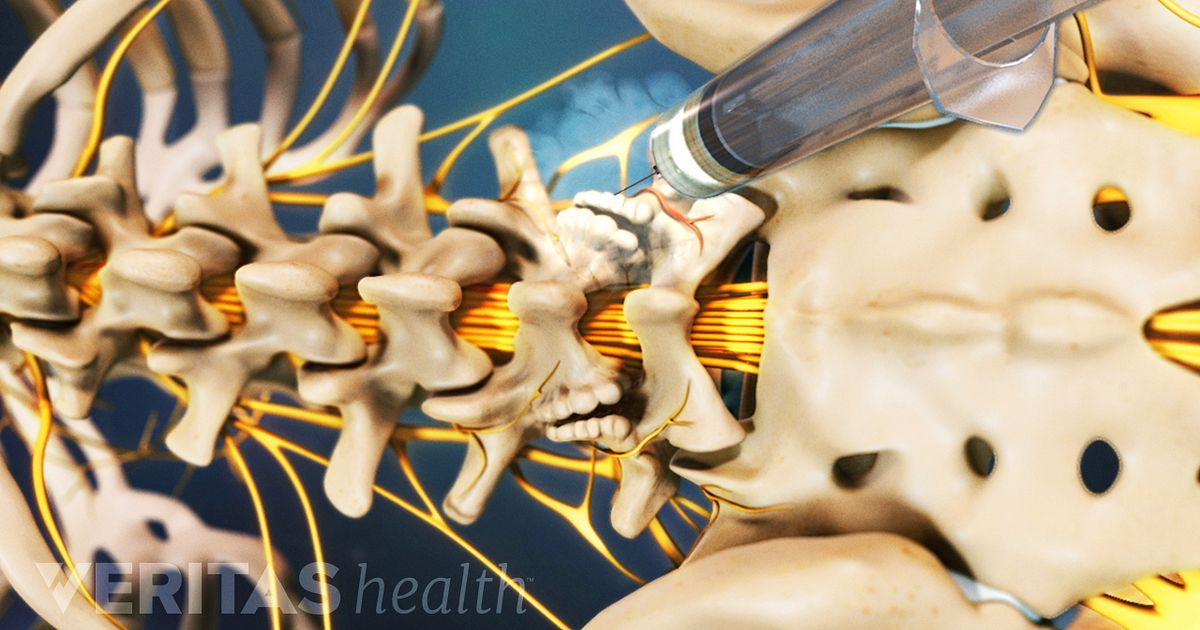 Facet Joint Nerve Block Injection   Facet Joint Injection Anesthetic 