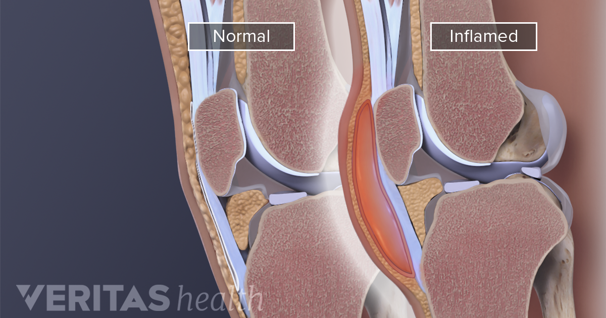 Knee (Prepatellar) Bursitis