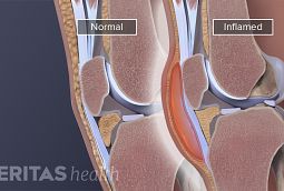 Pseudogout Symptoms