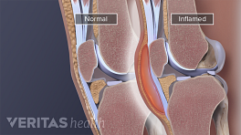 Cross section view of normal and inflamed bursae in the knee