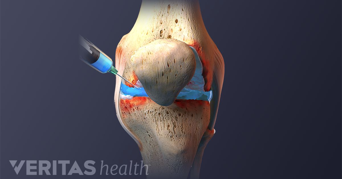 Viscosupplementation Procedure for Knee Osteoarthritis | Arthritis-Health