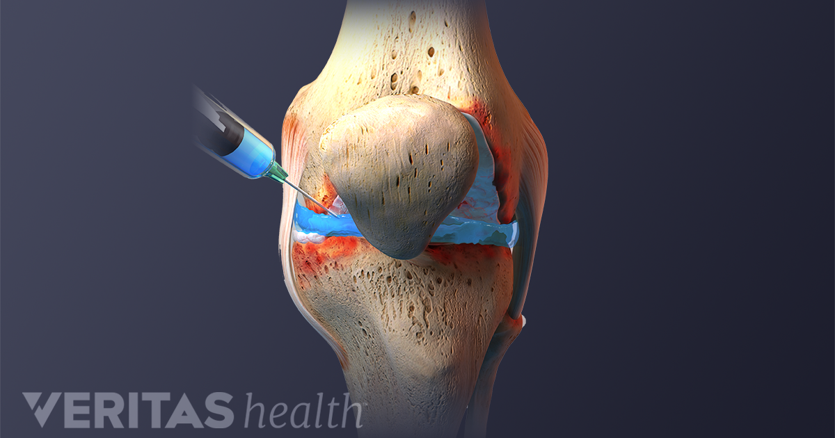 reumatism gel articular ce fac sportivii când rănesc articulațiile