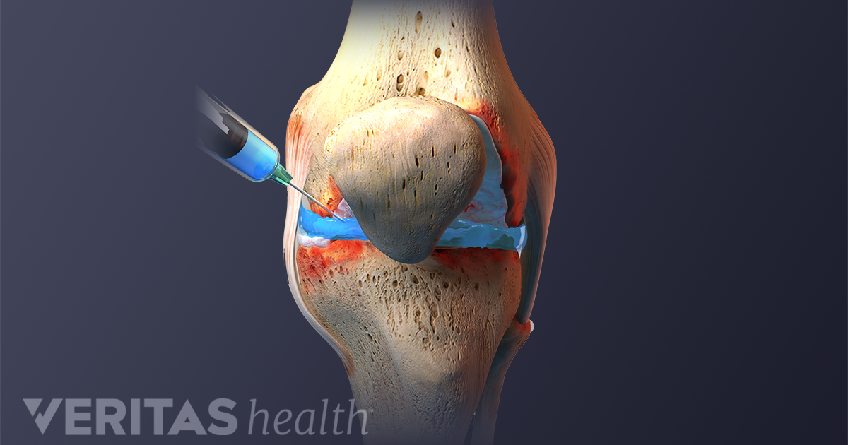 reumatism gel articular