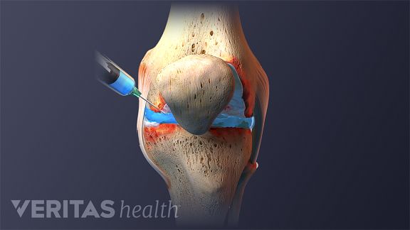 PRP injeção de ser injetado na articulação do joelho
