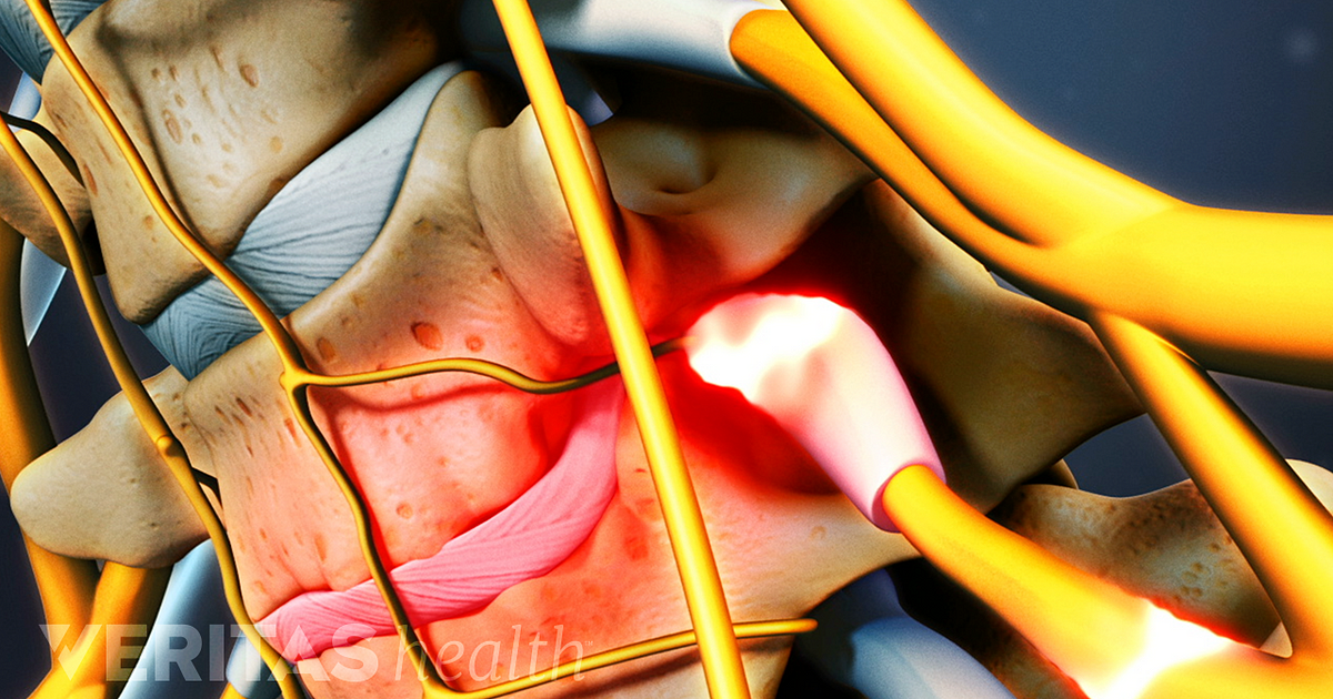 nerve-root-impingement-conditions-and-treatment