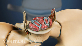 Superior view of ACDF device in S1 vertebra.