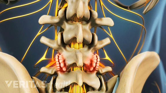 Lumbar osteophyte video still