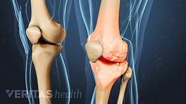 Medical illustration of the knee showing knee osteoarthritis