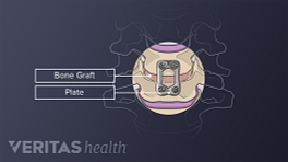 Illustration of fusion highlighting the bone graft and plate.