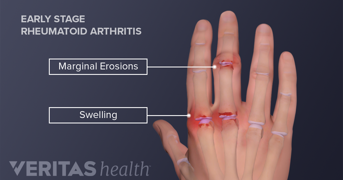 get-a-grip-on-rheumatoid-arthritis-in-the-hands-and-wrists