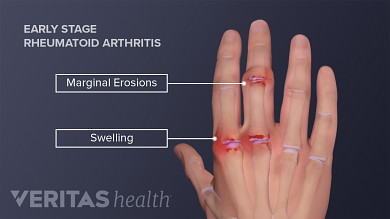 rheumatoid arthritis)