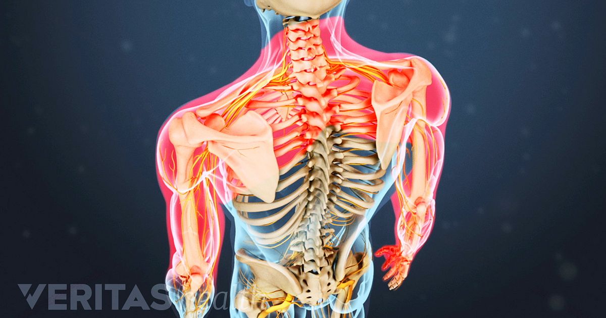 Diagnosing Cervical Radiculopathy vs. Other Causes of Hand ... rib  damage diagram 