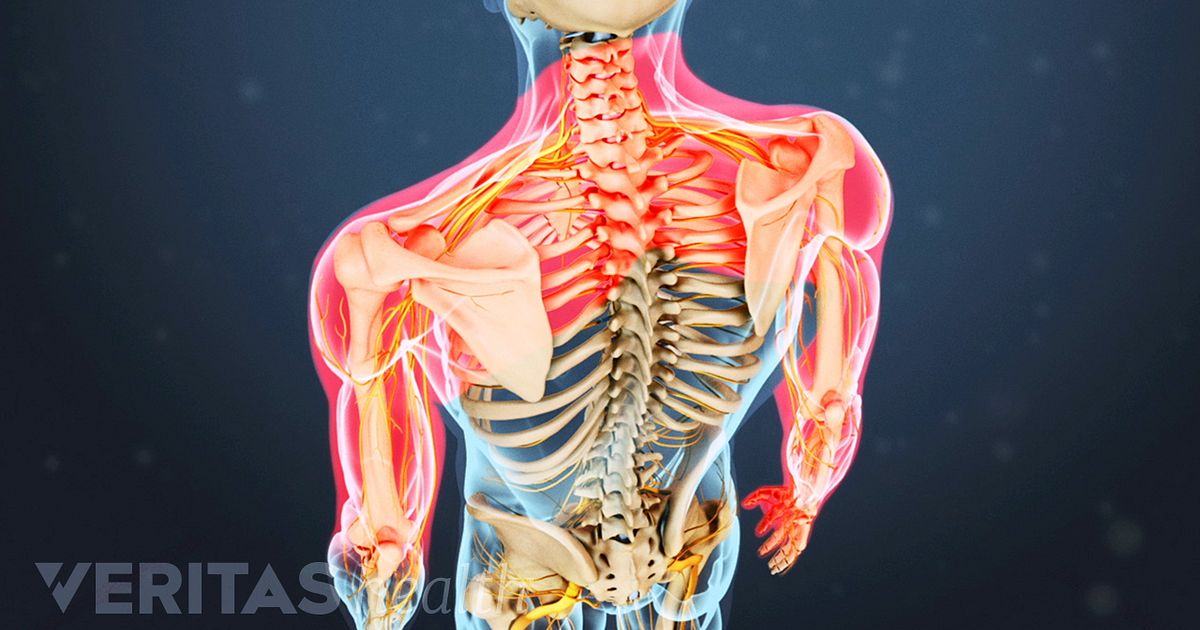 What You Need to Know About Fibromyalgia