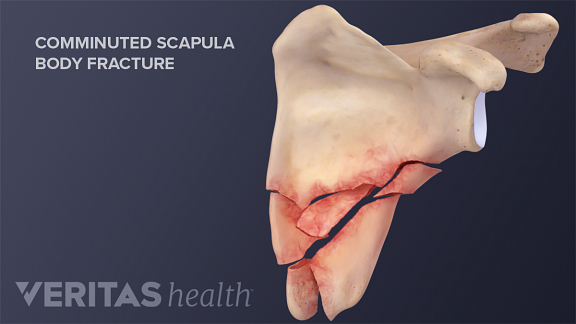adult scapula fracture