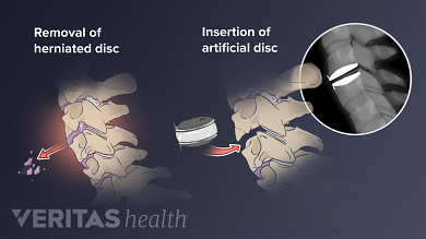 Evaluating Surgery For Artificial Disc Replacement