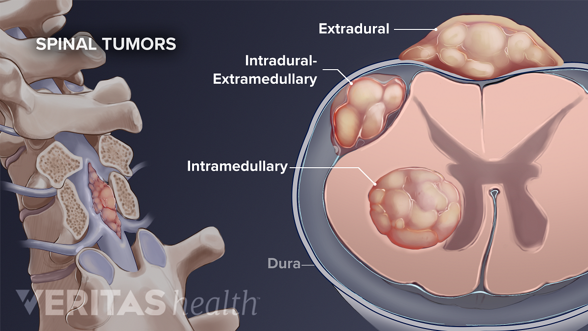 Metastatic Spinal Tumor Diagnosis