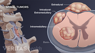 Metastatic Spine Tumors