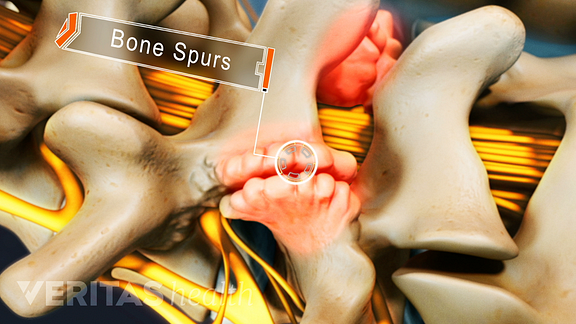 bilateral bone spurs