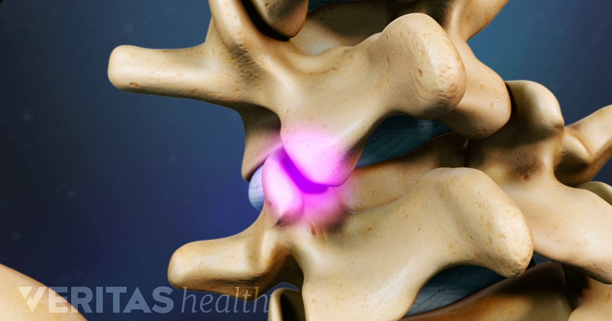 Treatment Options For Facet Joint Pain