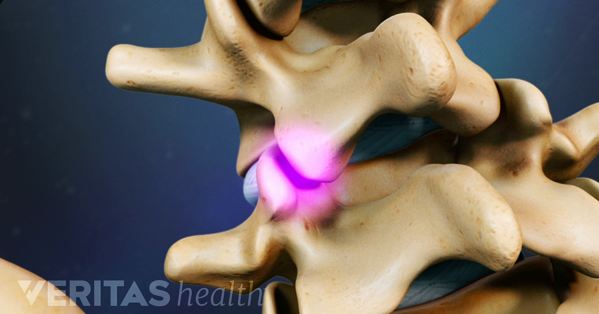 Treatment Options for Facet Joint Disorders