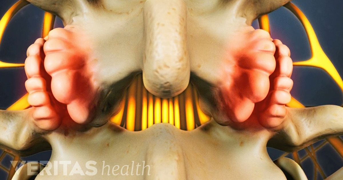 Understanding Lumbar Osteophytes (Bone Spurs)