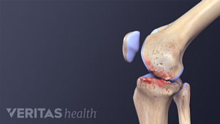 Viscosupplementation For Knee Osteoarthritis | Arthritis-Health