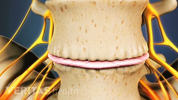 Degeneration of the lumbar spine (and the development of lumbar osteophytes) can occur as a result of aging.